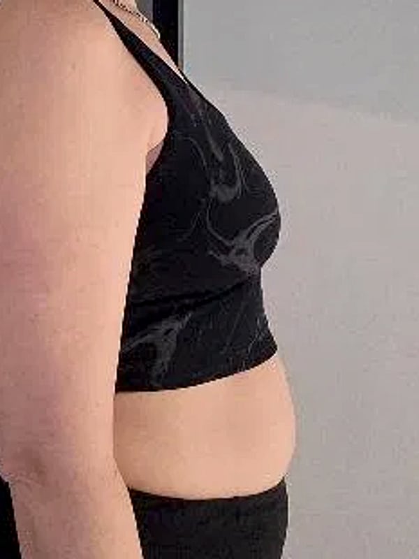 Katie P., side profile midsection, before her plan.
